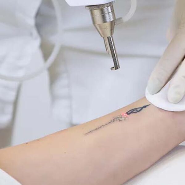 Laser Tattoo Removal